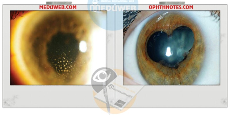 Phacoemulsification is scheduled on Uveitic patients 2 Phacoemulsification is scheduled on Uveitic patients