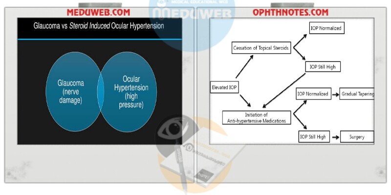 Pearls in Steroid Induced ocular HTN