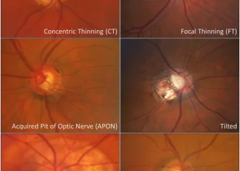 Common optic disc signs and it’s DD