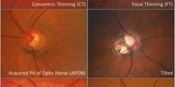 Common optic disc signs and it’s DD