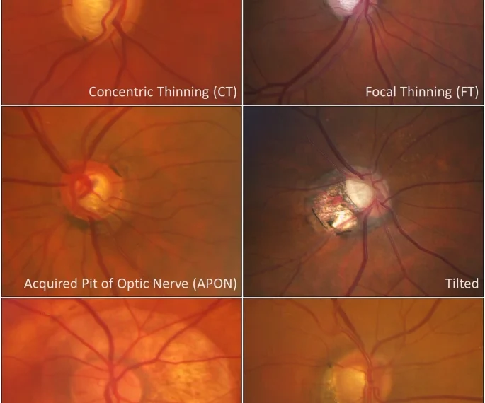 Common optic disc signs and it’s DD