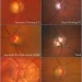 Common optic disc signs and it’s DD