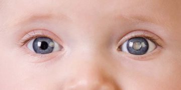 Pediatric cataracts
