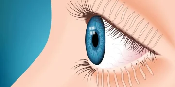 Meibomian gland dysfunction
