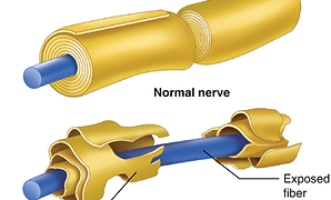 Guillain-Barré Syndrome (GBS)
