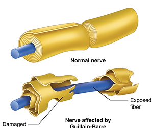 Guillain-Barré Syndrome (GBS)