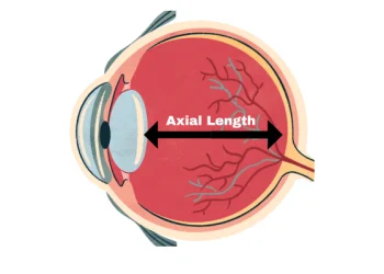 Clinical notes on Axial Length in Long Eyes
