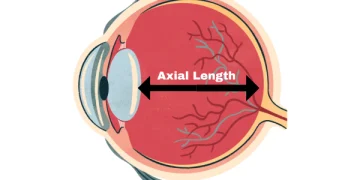 Clinical notes on Axial Length in Long Eyes