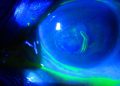 Recurrent corneal erosion syndrome (RCES)