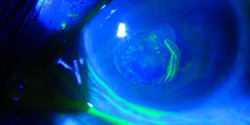 Recurrent corneal erosion syndrome (RCES)