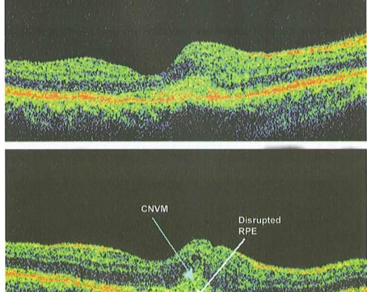 Optical coherence tomography ( OCT) 2 Optical coherence tomography ( OCT)