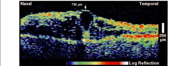 OCT interpretation capsules