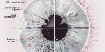 Uveitis in kids short messages