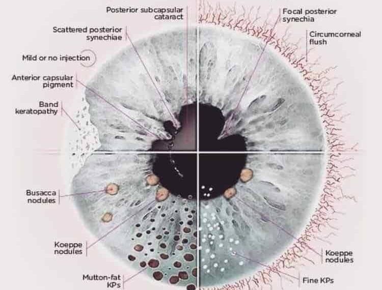 Uveitis in kids short messages
