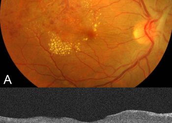 Retinal vasculitis
