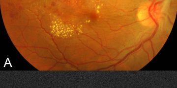 Retinal vasculitis