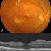 Retinal vasculitis