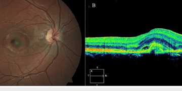 Choroidal Neovascular Membrane