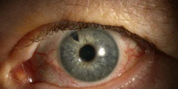 Glaucomatocyclitic crisis ( Posner- schlozman syndrome )