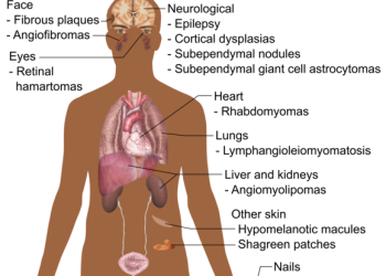 Tuberous sclerosis short message
