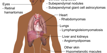 Tuberous sclerosis short message