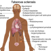 Tuberous sclerosis short message