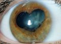 Phacoemulsification is scheduled on Uveitic patients
