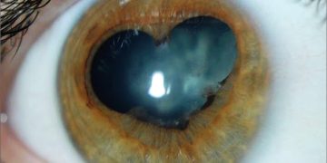 Phacoemulsification is scheduled on Uveitic patients