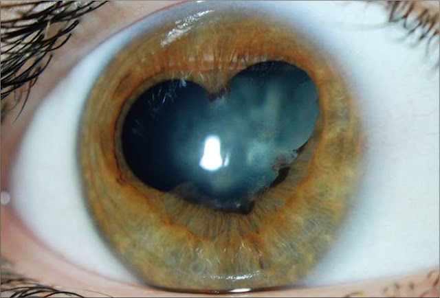 Phacoemulsification is scheduled on Uveitic patients 1 Phacoemulsification is scheduled on Uveitic patients