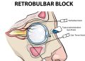 Anesthetics in Ophthalmic practice