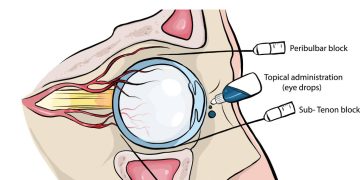 Anesthetics in Ophthalmic practice