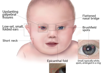 Ocular associations of Down Syndrome