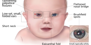 Ocular associations of Down Syndrome