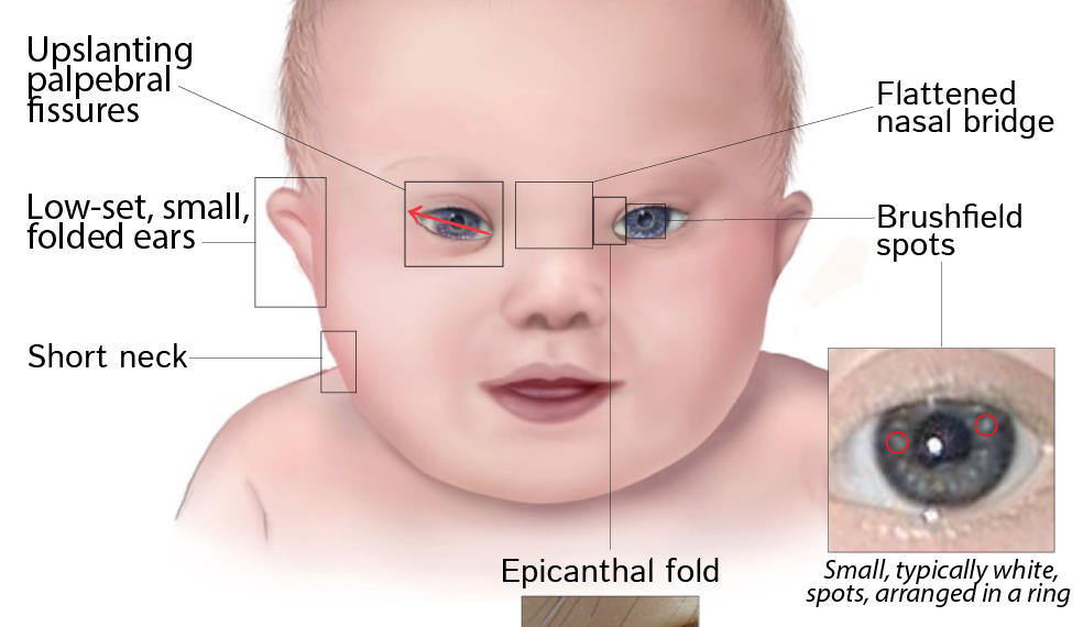 Ocular associations of Down Syndrome