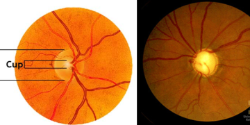 Optic Disc Changes In Glaucoma