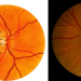 Optic Disc Changes In Glaucoma