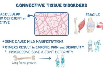 Common Ophthalmic Connective tissue disorder