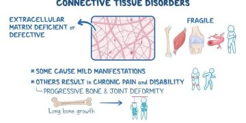 Common Ophthalmic Connective tissue disorder