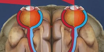 Clinical hints for hemianopic patient suffering with reading