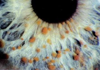 Neurofibromatosis (NF)short message