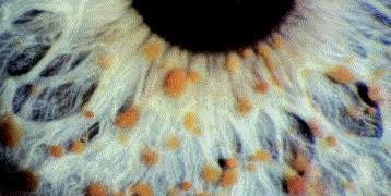 Neurofibromatosis (NF)short message