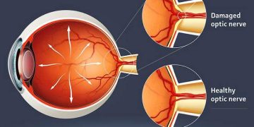Whether to treat ocular HTN and glaucoma suspect or not to treat ( debatable issue )