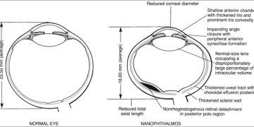 Specific precautions when operating Nanophthalmic eye